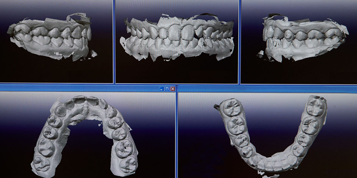 digital intraoral scans